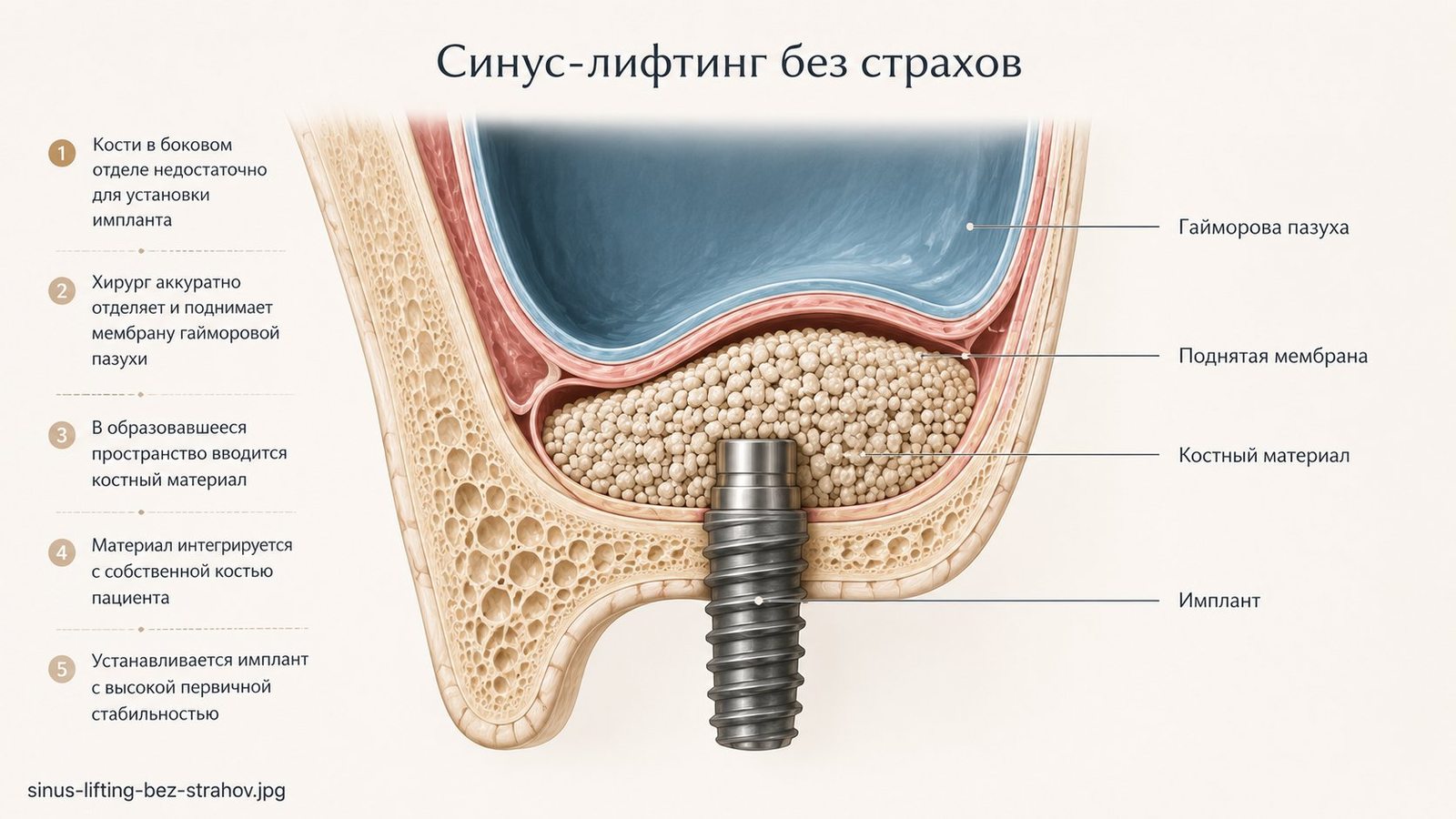 Синус-лифтинг — анатомия верхней челюсти и гайморовой пазухи